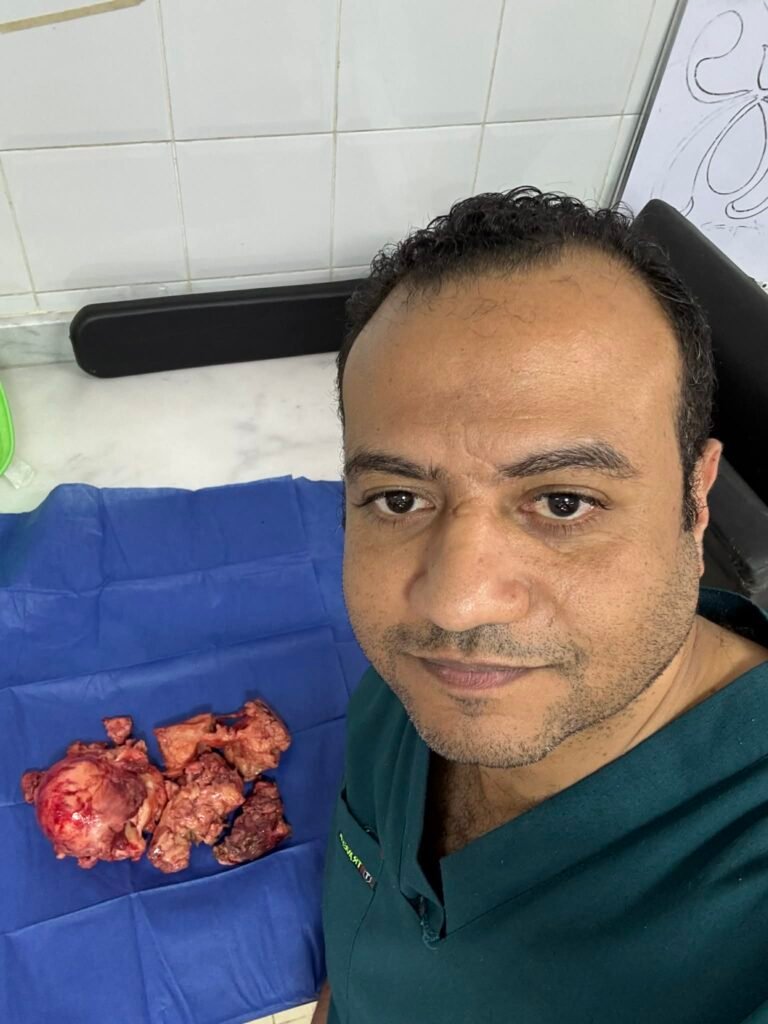 استئصال رحم كبير بالمنظار