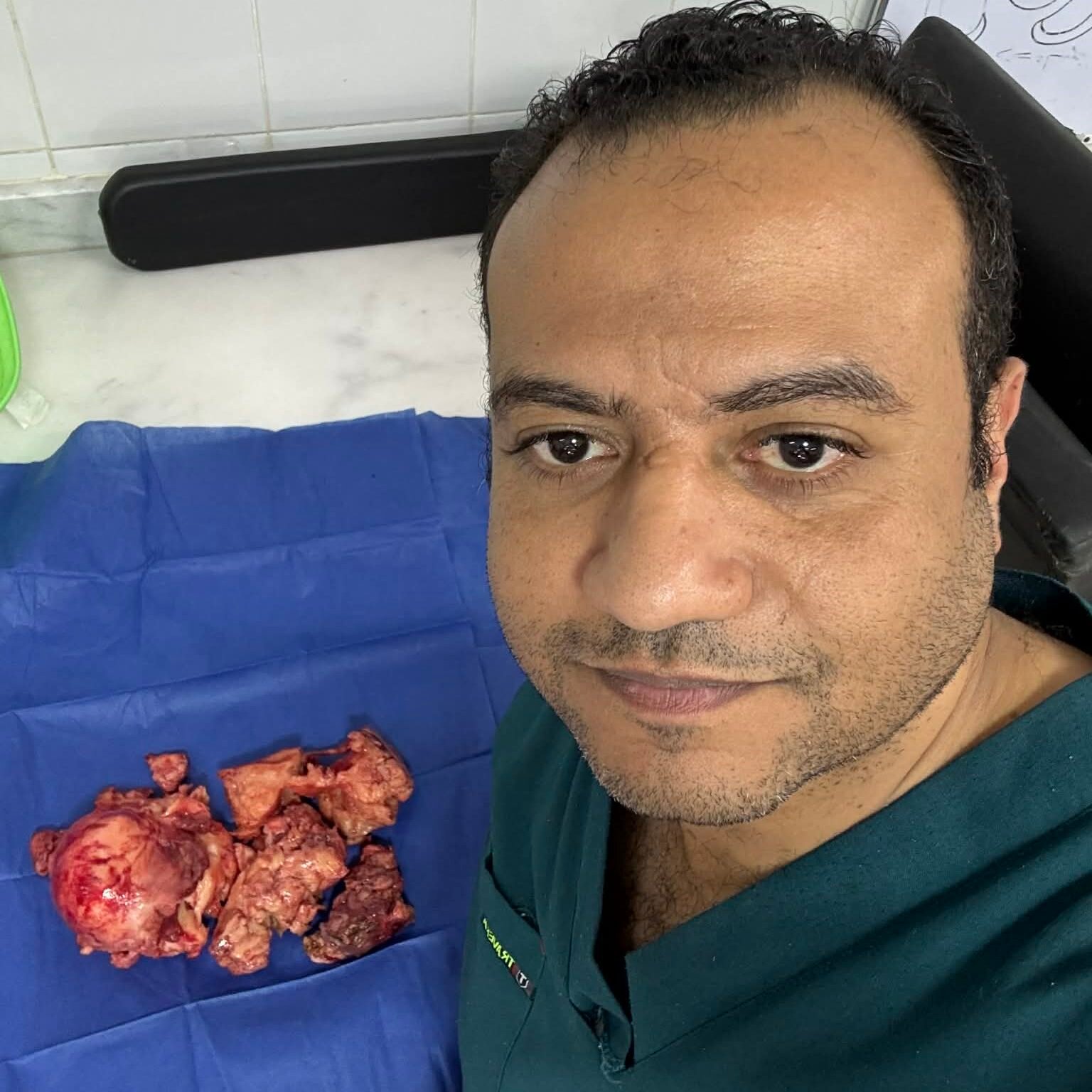 استئصال رحم كبير بالمنظار