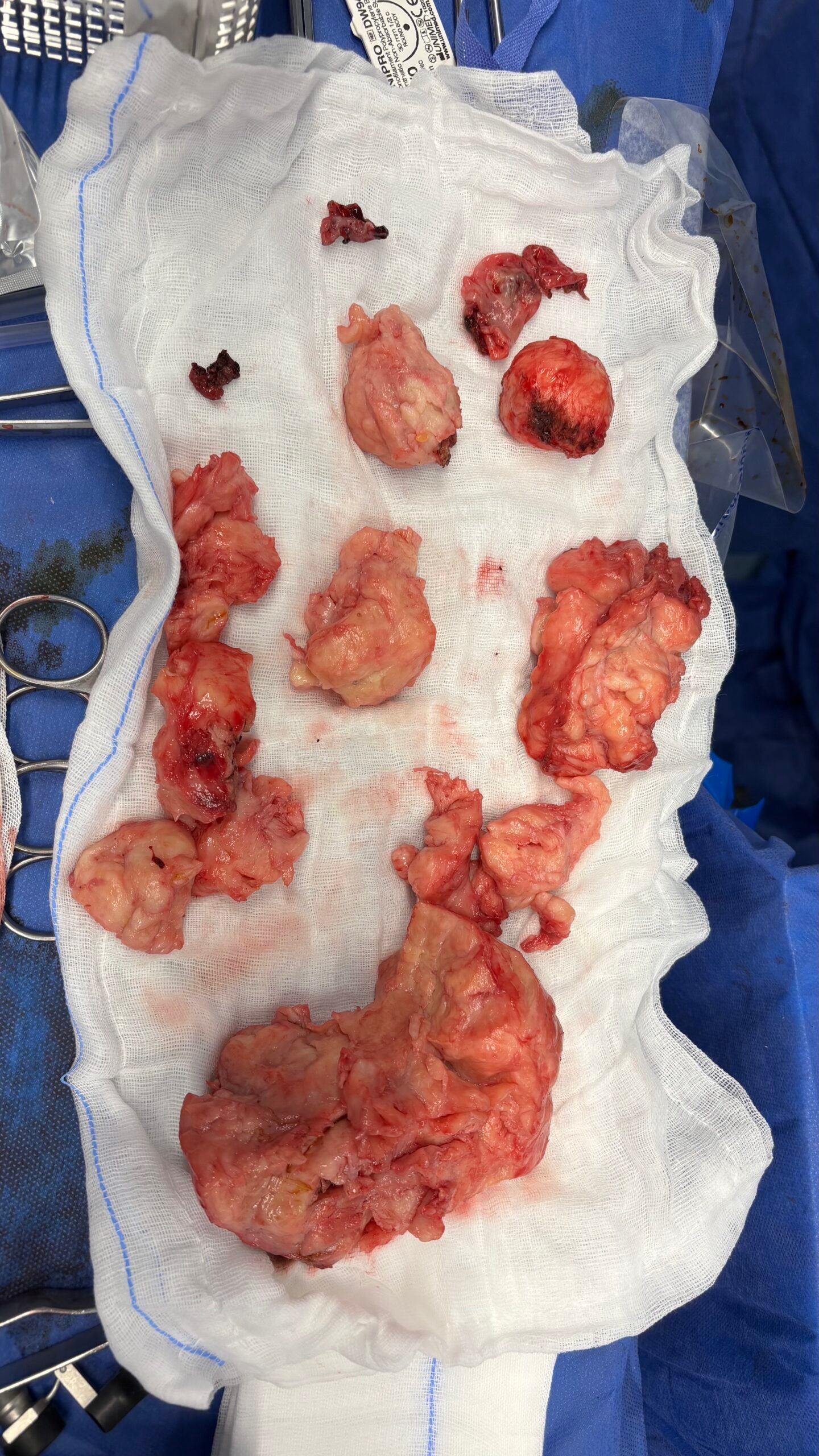 استئصال الاورام الليفية بالمنظار