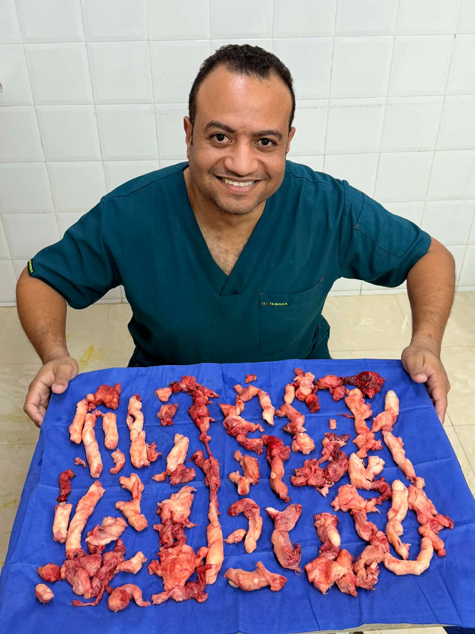 استئصال الورم الليفي الكبير بالمنظار