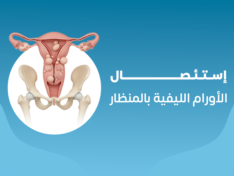إستئصال الأورام الليفيه بالمنظار