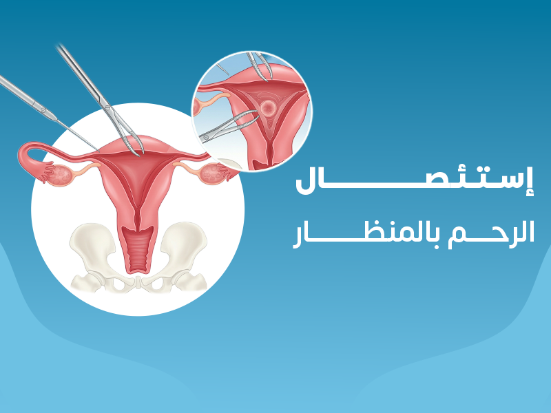 إستئصال الرحم بالمنظار