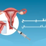 علاج اسباب تأخر الانجاب 4 التلقييح الصناعي