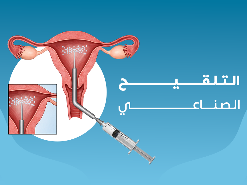 التلقييح الصناعي