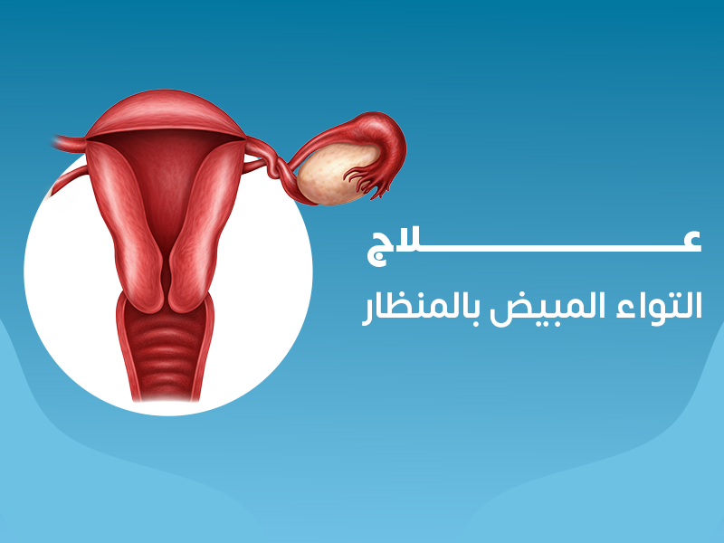 علاج التواء المبيض بالمنظار