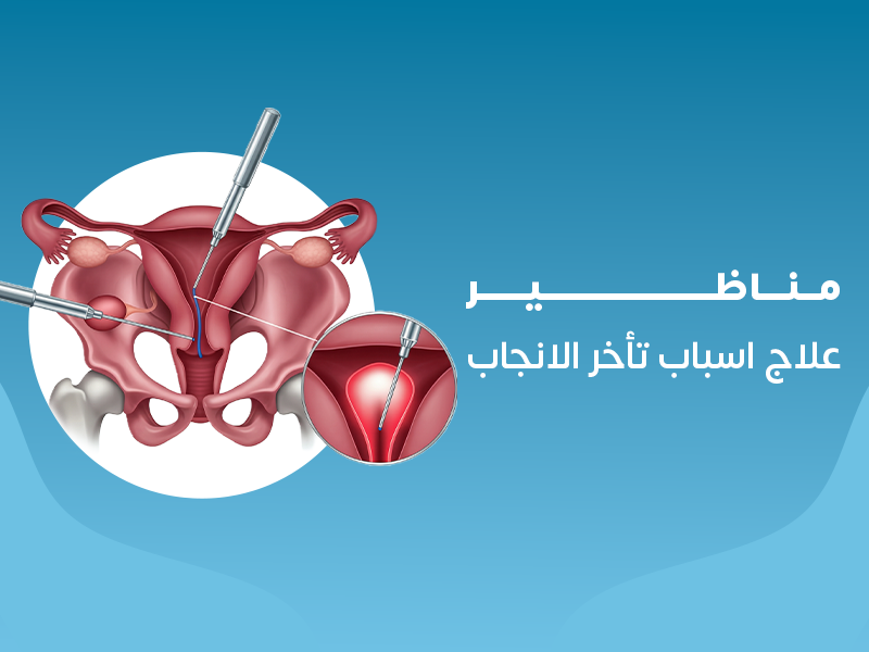 مناظير علاج أسباب تأخر الإنجاب