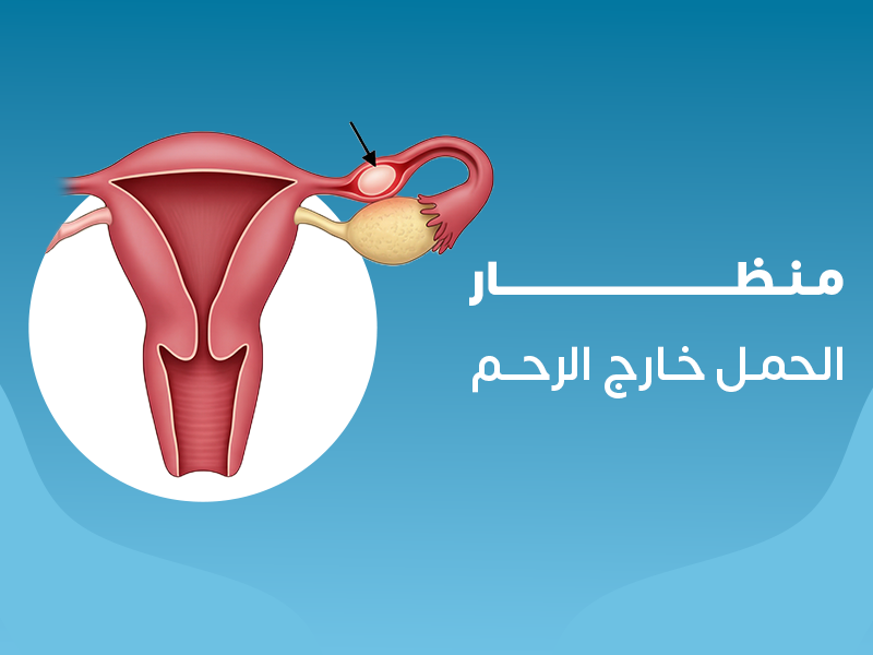 منظار الحمل خارج الرحم