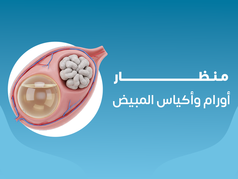 منظار اورام اكياس المبيض