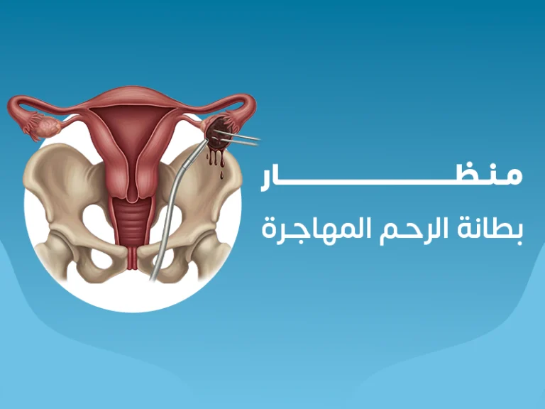أ.د/ محمد فوزي الطويل – جراح التوليد وأمراض النساء بالسويس 10 علاج بطانة الرحم المهاجرة بالمنظار في السويس