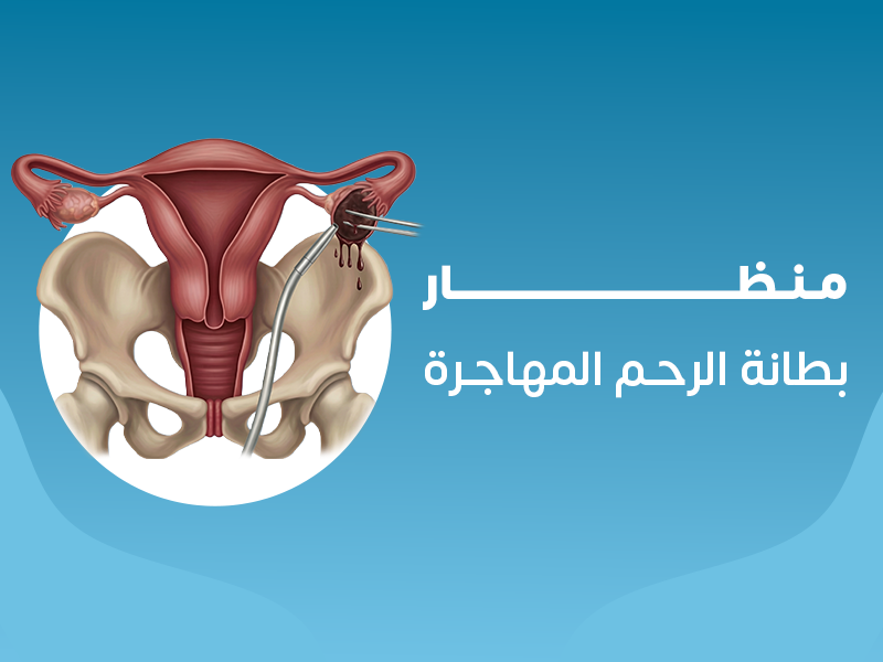 علاج بطانة الرحم المهاجره بالمنظار