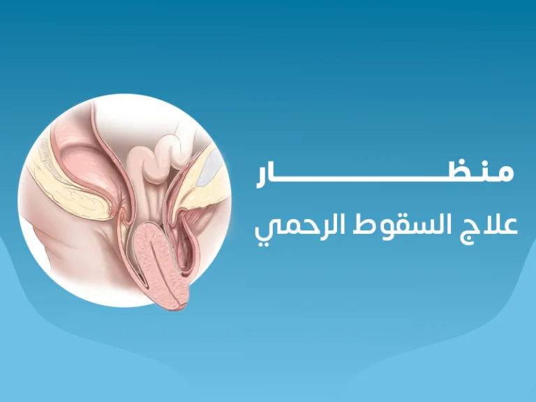 منظار علاج السقوط الرحمى