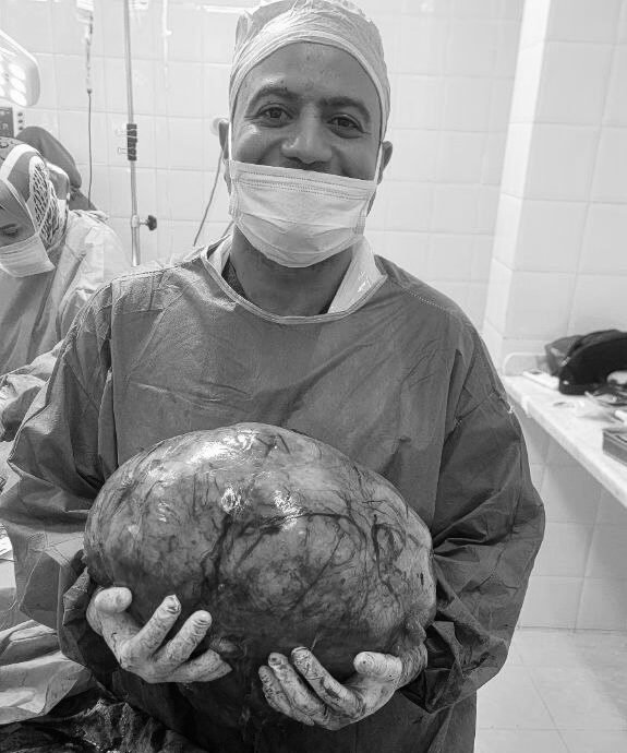 رحم وزنه 15 كيلوجرام استُئصل بنجاح بالجراحة التقليدية فتح البطن