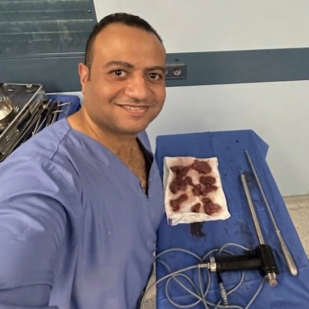 استئصال الاورام الليفية بالمنظار