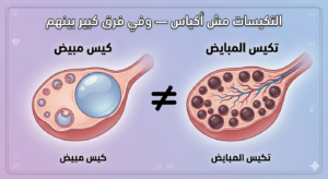 تكيسات المبايض ليست أكياس علي المبيض