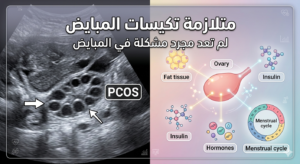 الفهم القديم والحديث لتكيسات المبايض