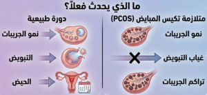 تكيسات المبايض ماذا يحدث؟