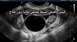 مناظير أكياس و أورام المبيض
